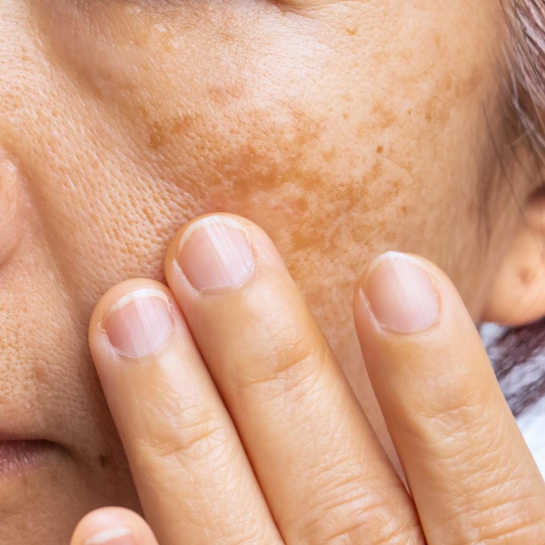 closeup of a woman's face suffering from hyperpigmentation