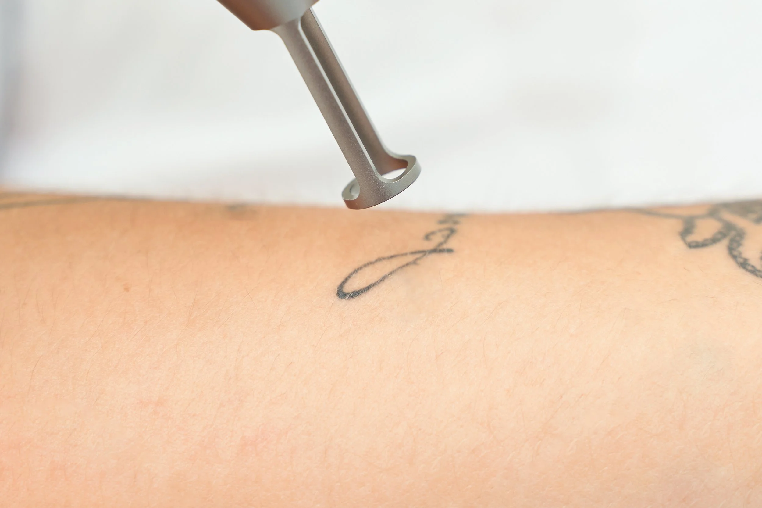 Closeup of Tattoo removal instrument before laser tattoo removal treatment