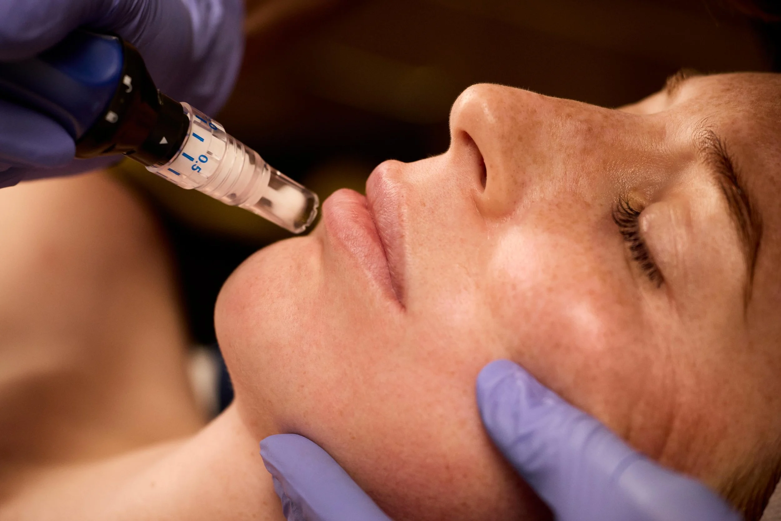 Woman receiving SkinPen treatment in the office at Derma