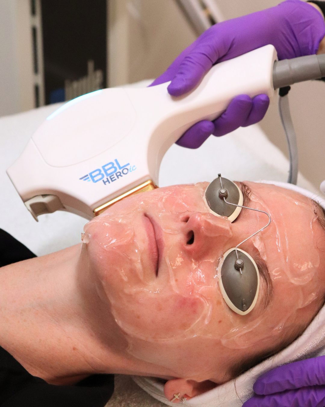 Patient receiving BBL Heroic laser treatment for Acne Scars