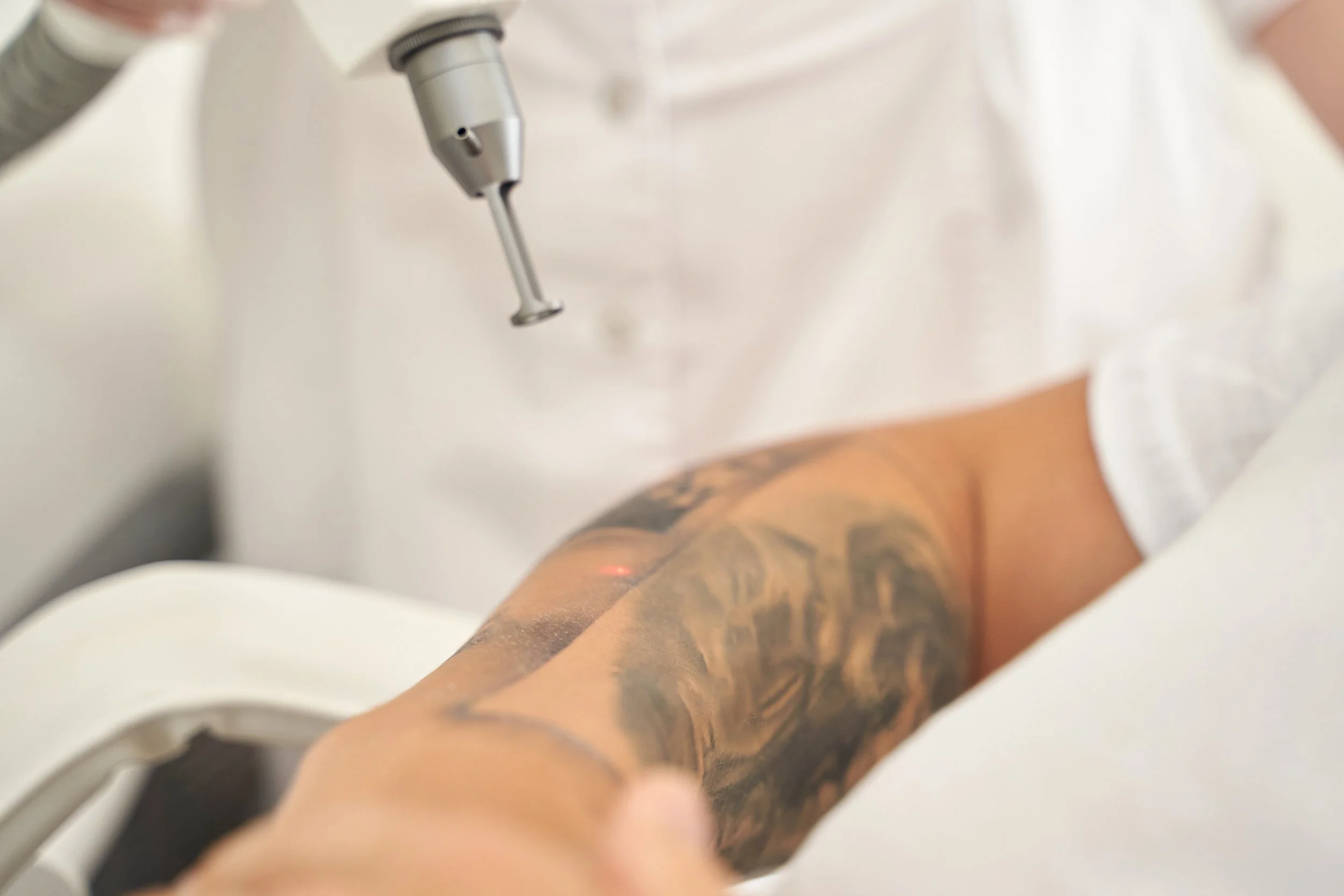 laser removal on an existing tatoo