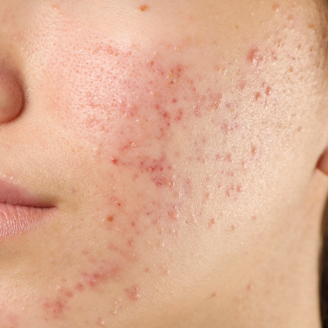 image of acne on the face of a caucasian person