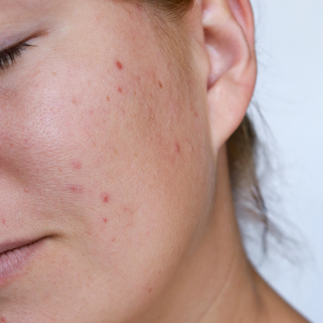 Closeup of a womans skin in need of a chemical peel
