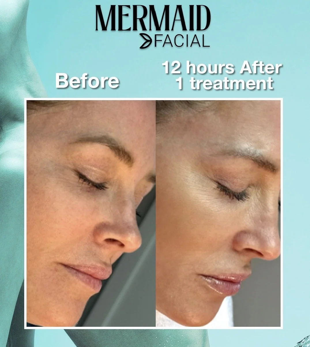 A side-by-side comparison of a woman's face showing 'before' and '12 hours after 1 treatment' results of a facial procedure, with smooth skin and improved complexion.