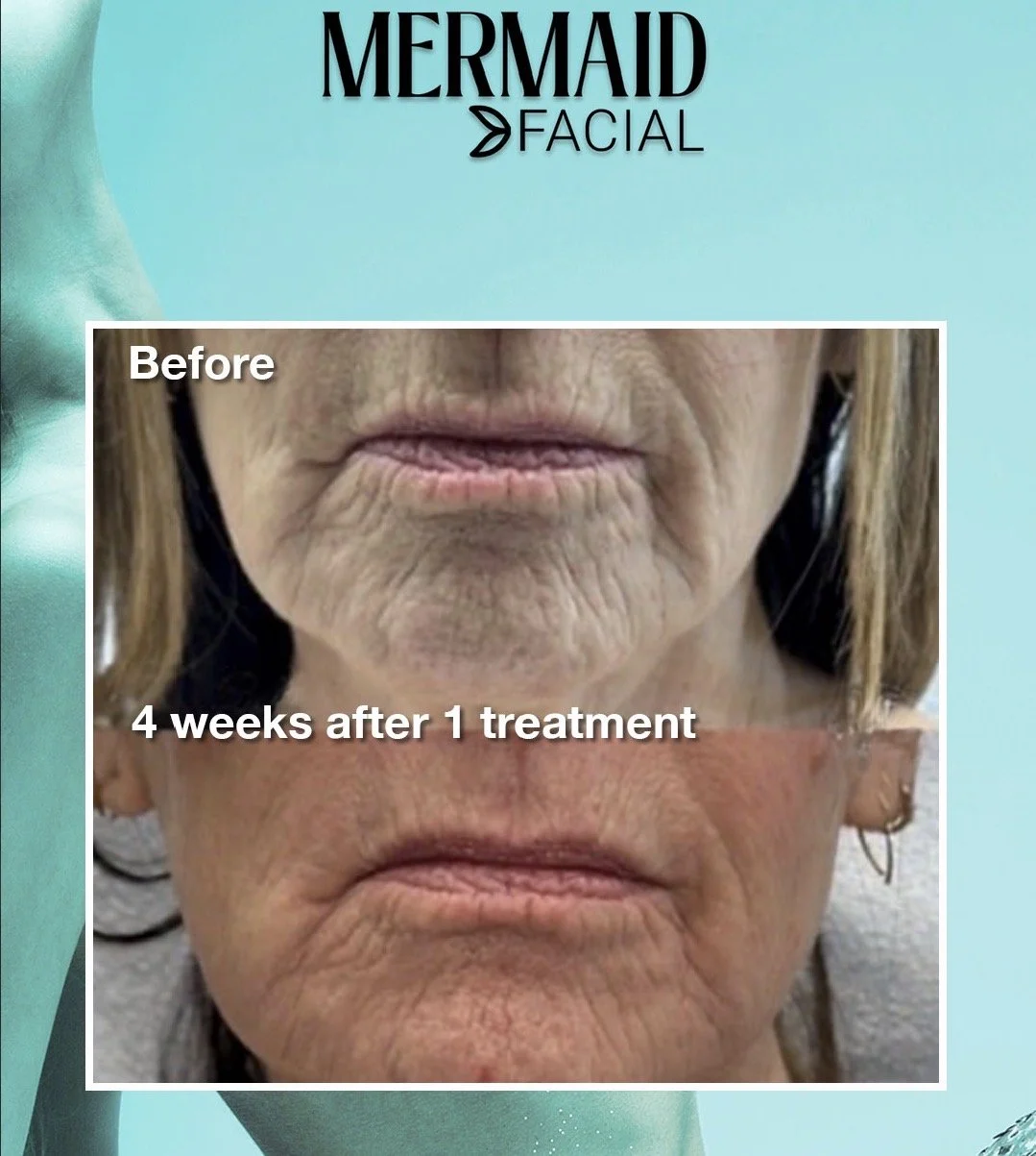 Comparison of a woman's lips and surrounding skin before and four weeks after facial treatment, showing reduced wrinkles and smoother skin.