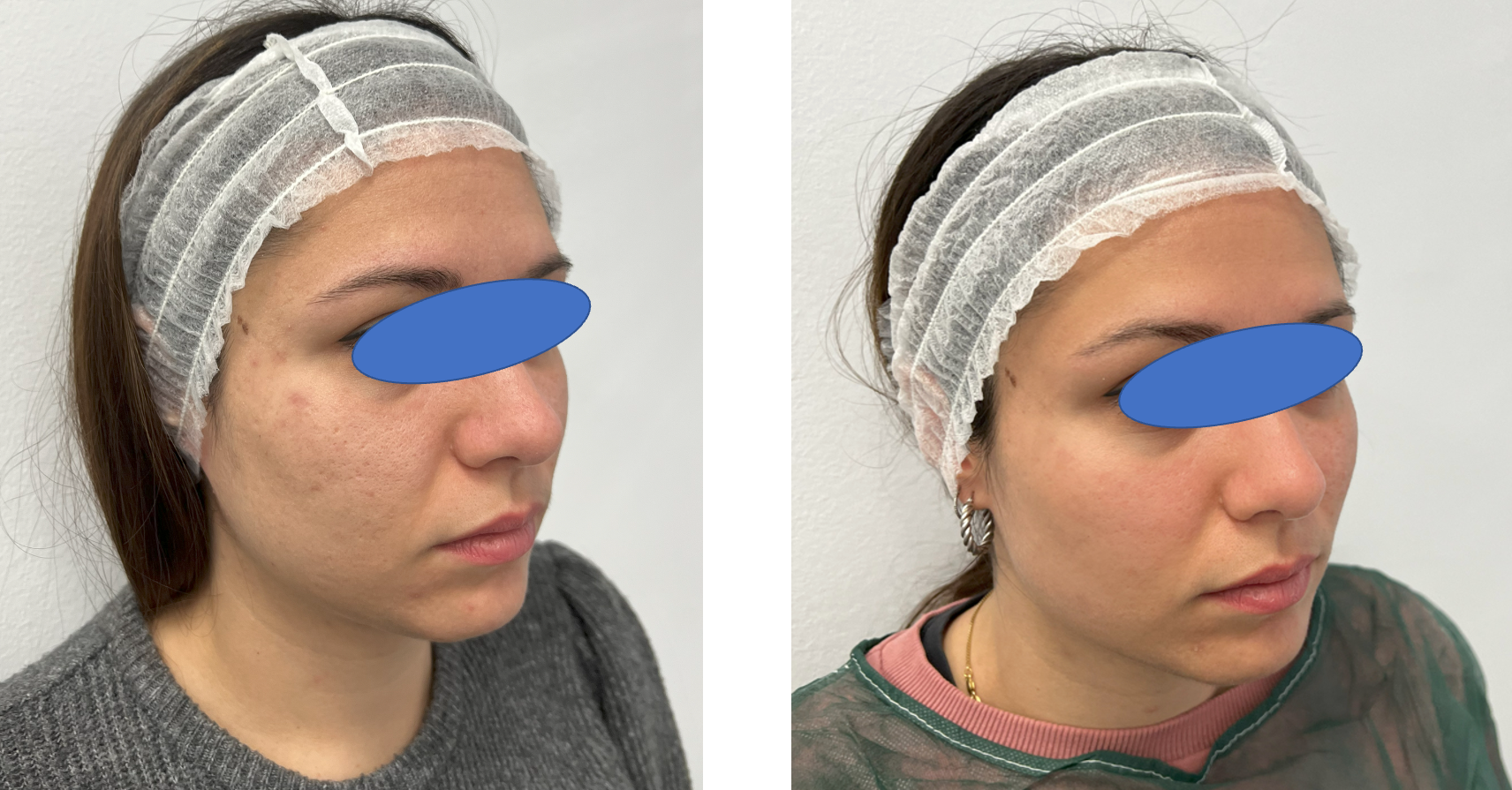 Before and after comparison of a woman's face showing improvement in skin texture and acne scars, with the woman wearing a disposable hair cap in both images.