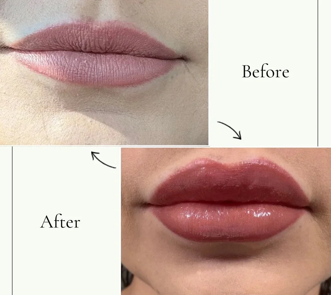 B&A lip enhancement - immediate results 