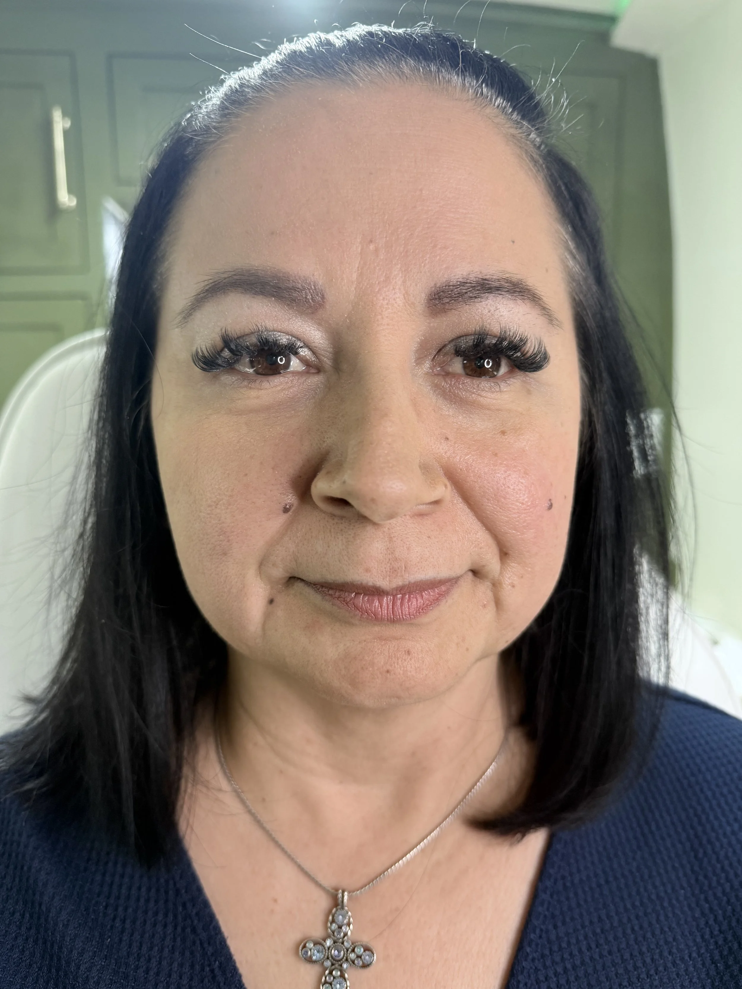 Before Collagen Stimulation smile lines