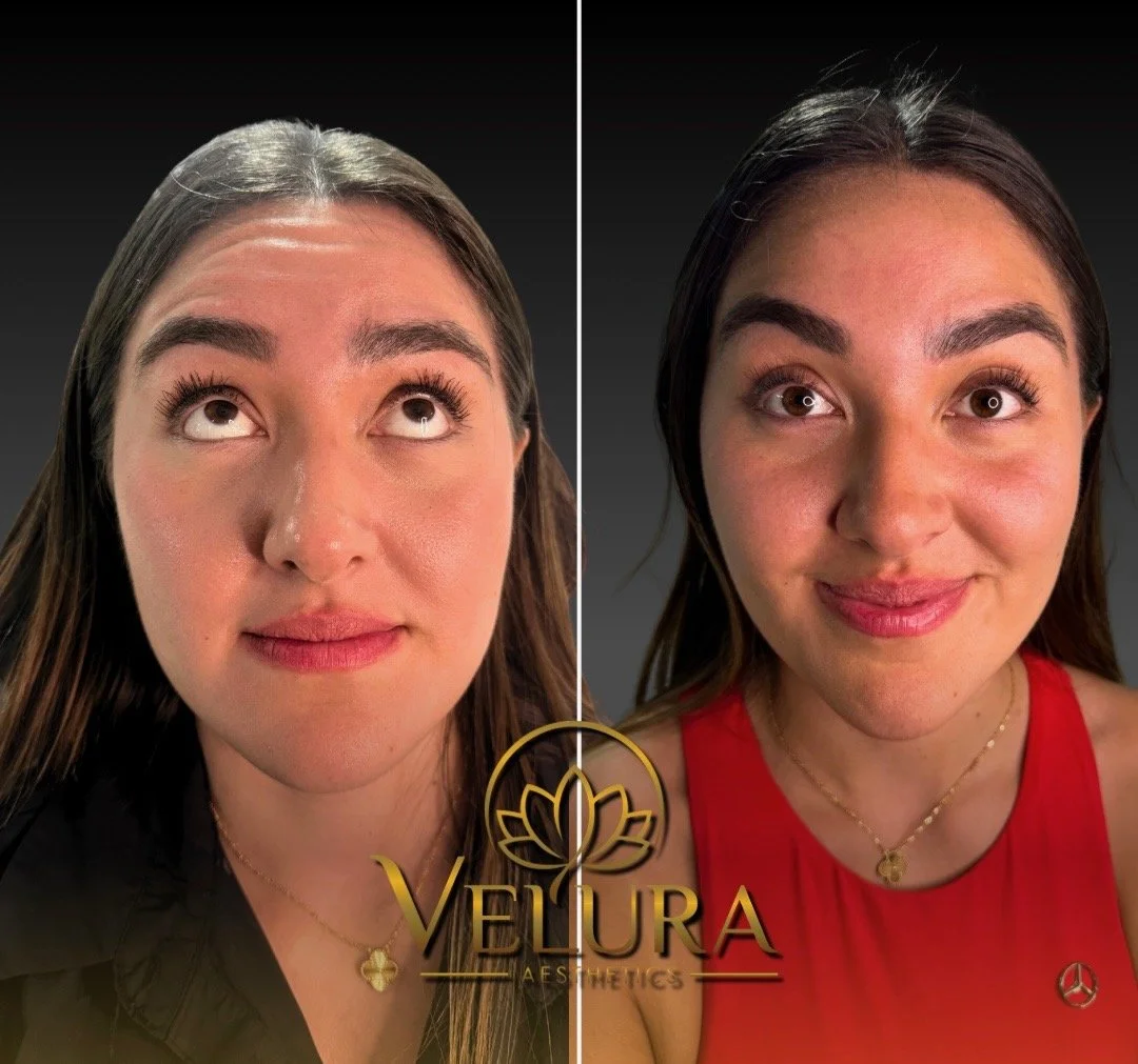 B&A botox - 2 weeks results 