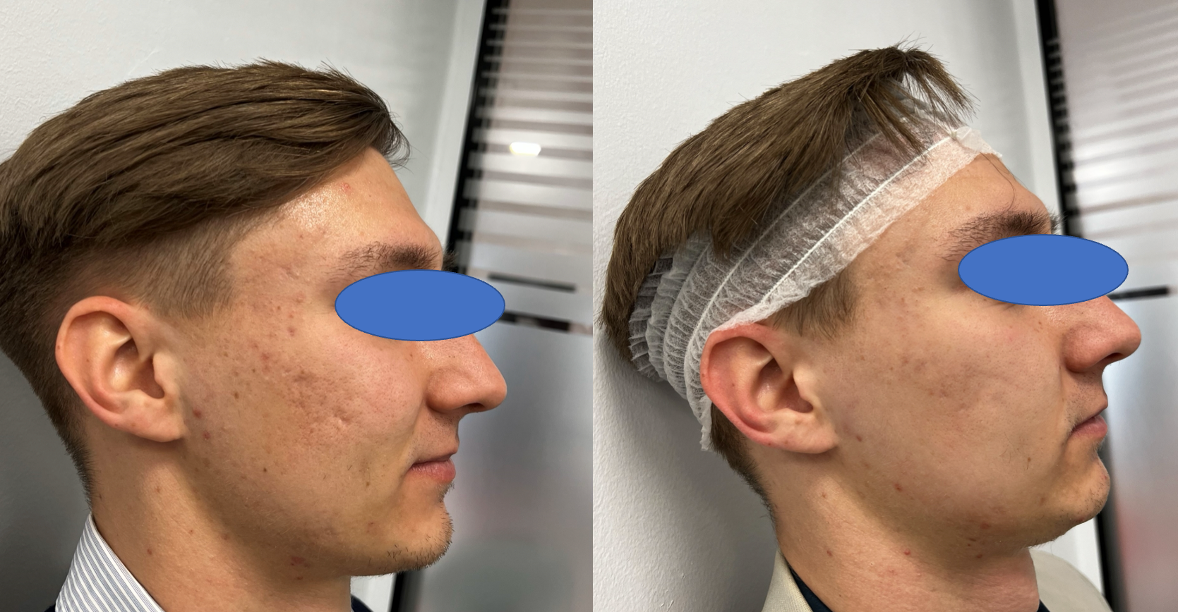 Side-by-side comparison of a young man's face before and after a skincare or dermatological treatment, with the 'after' image showing clearer skin and a hair covering.