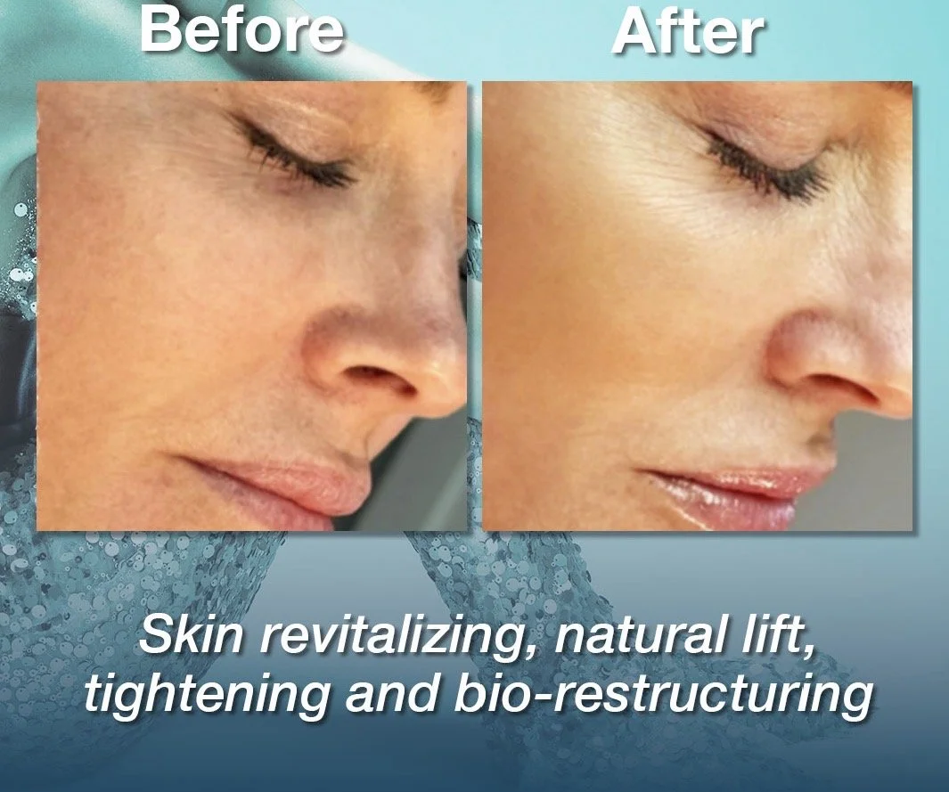 Side-by-side comparison of a woman's face showing skin improvement before and after a skincare treatment, with text indicating skin revitalization, natural lift, tightening, and bio-structuring.