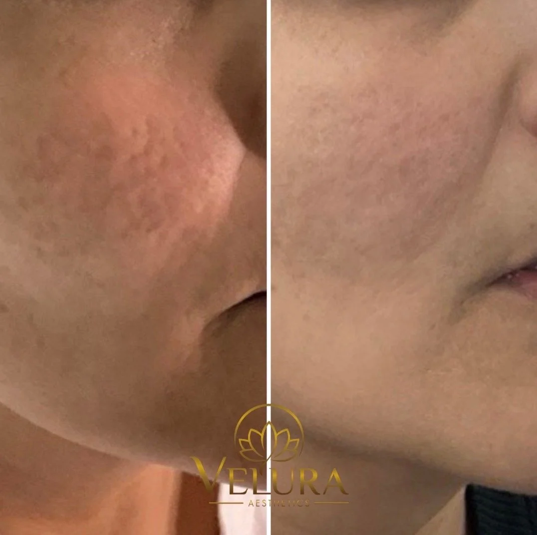 Microneedling - 4 weeks results 