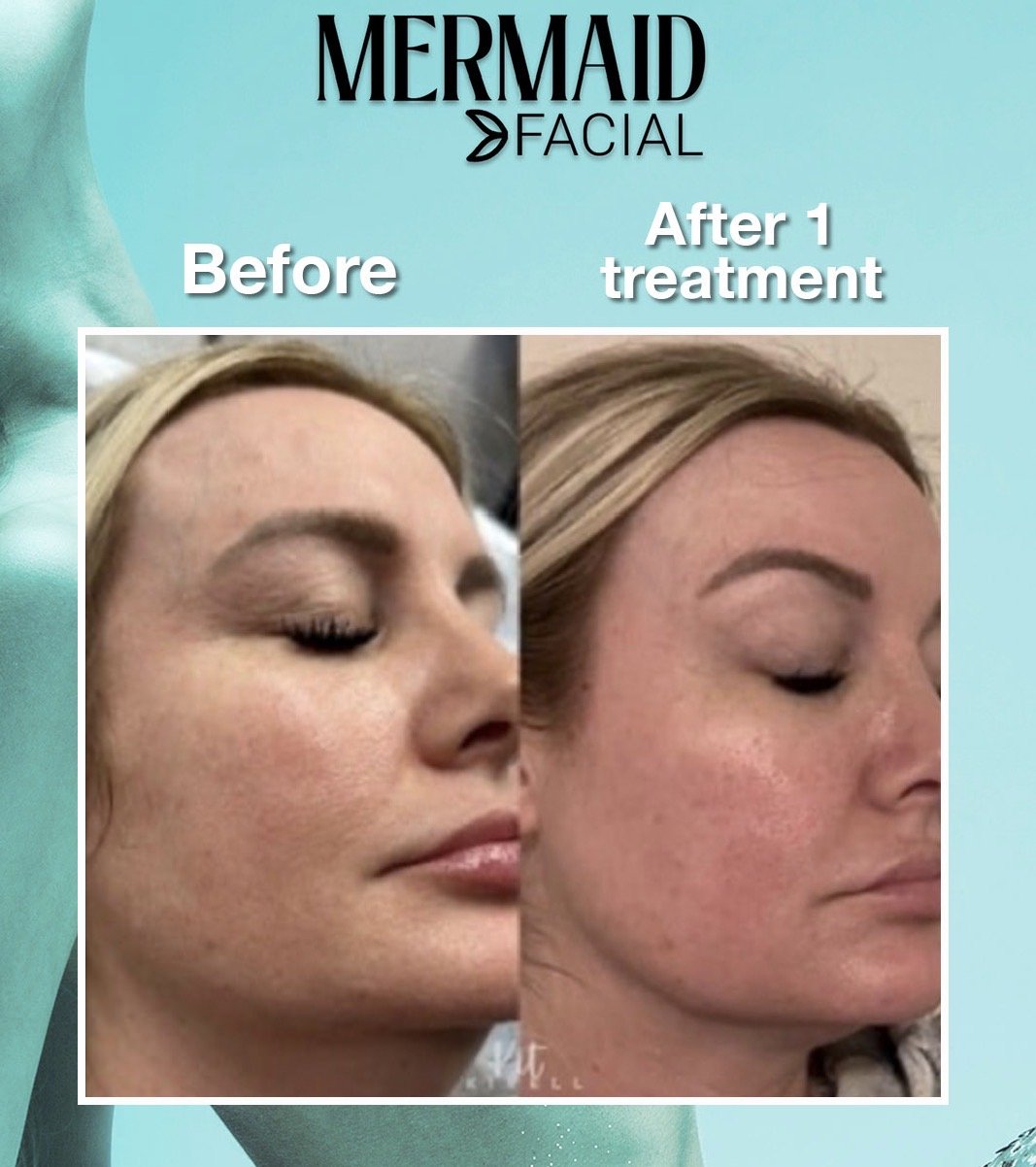 Comparison of a woman's face before and after one facial treatment, showing clearer, smoother skin.