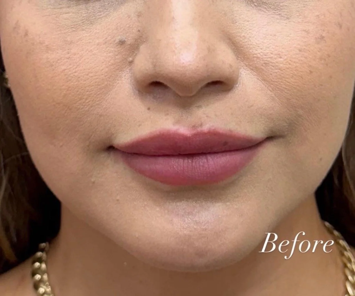 Before filler smile lines 