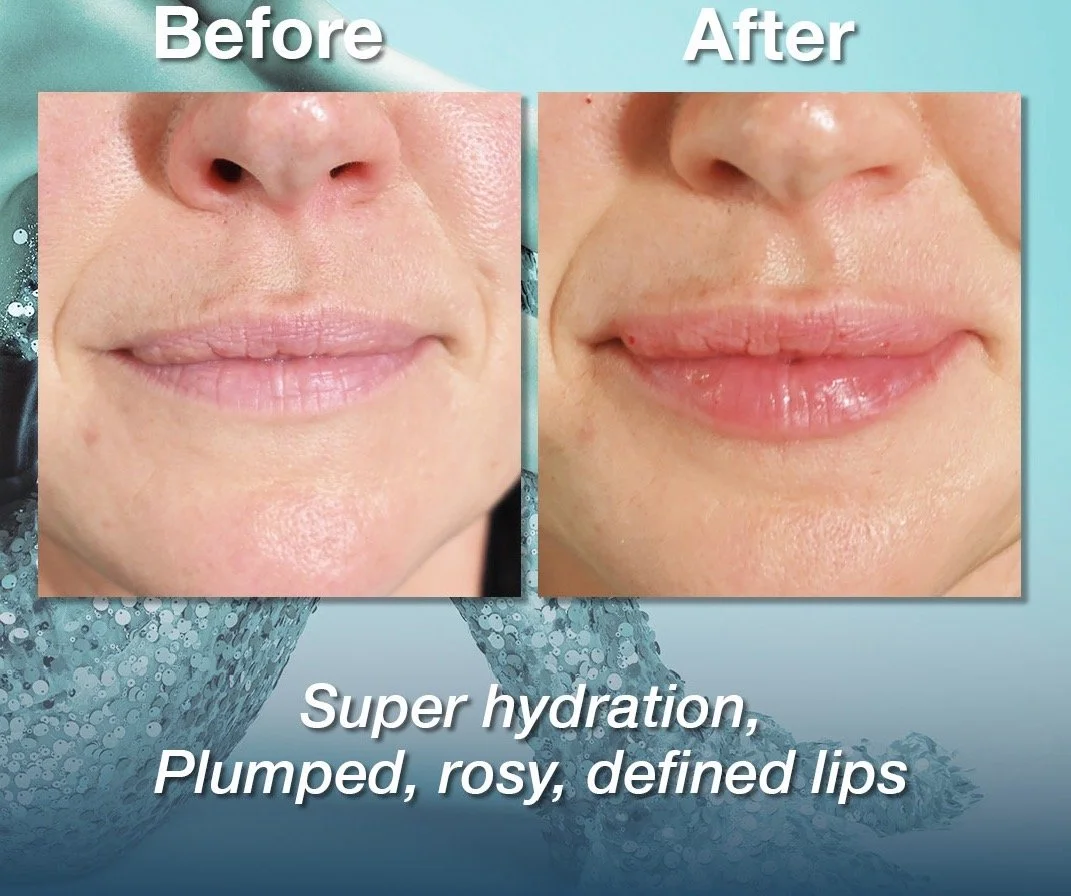 Comparison of a woman's lips before and after hydration treatment. The "before" photo shows dry, pale lips, while the "after" photo shows plumper, rosier, and more defined lips with a glossy finish.