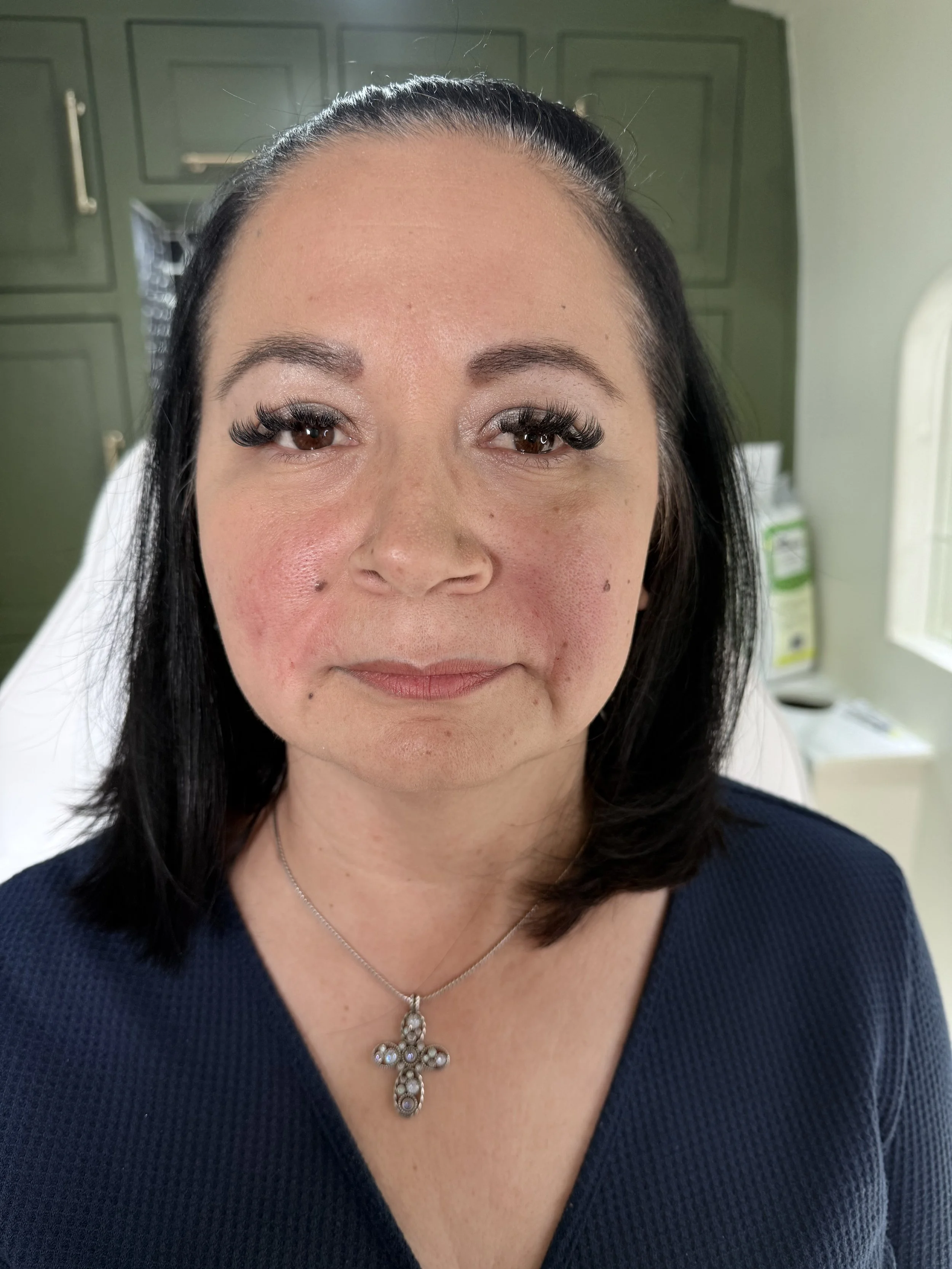 After Collagen Stimulation smile lines - Immediate results