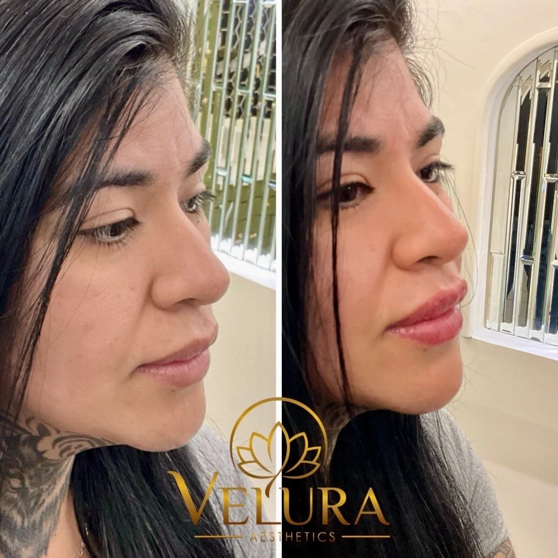 B&A lip enhancement - immediate results 