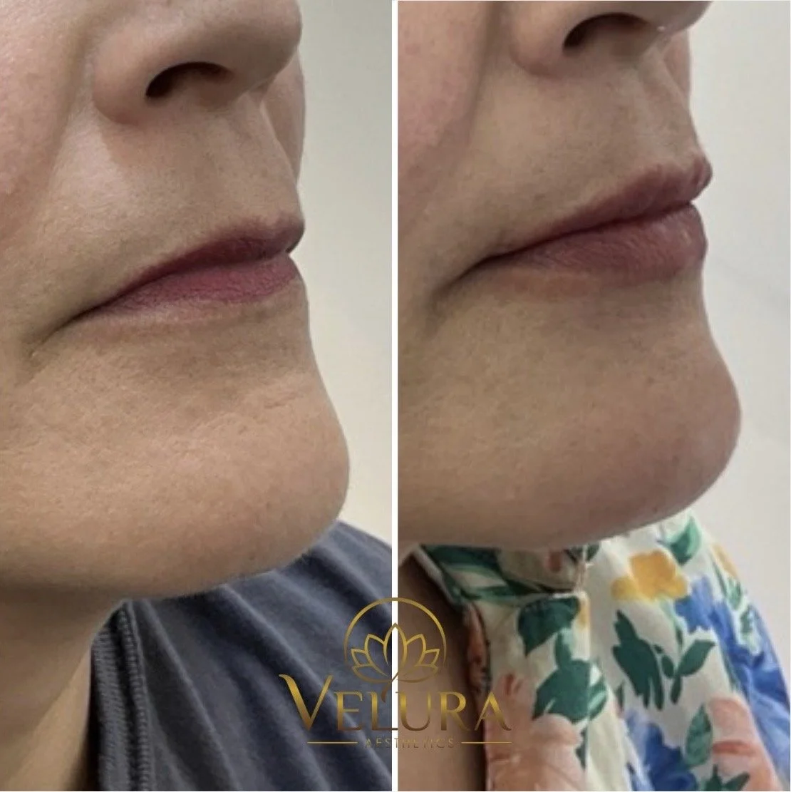 B&A lip enhancement - immediate results 