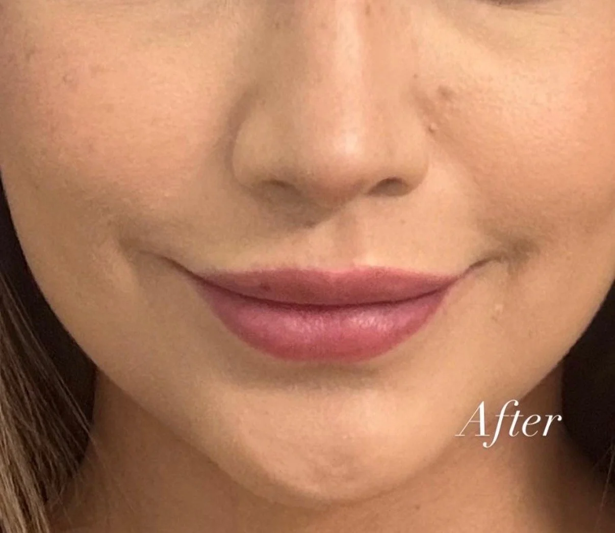 After filler smile lines - immediate results 