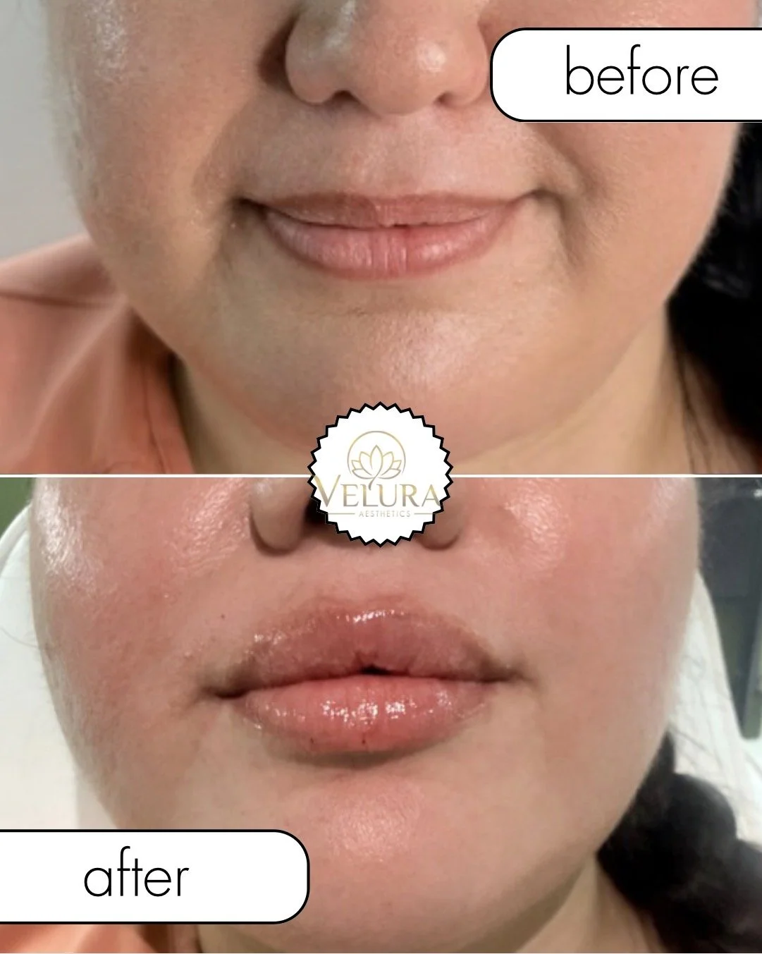 B&A mini lip enhancement - immediate results 