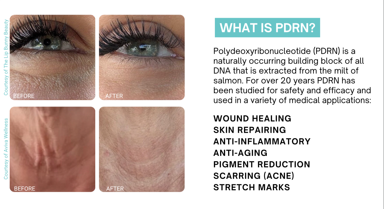 Side-by-side before and after photos of skin improvements on eyes and a nose, demonstrating the effects of PDRN treatment, with informational text about PDRN uses and benefits.