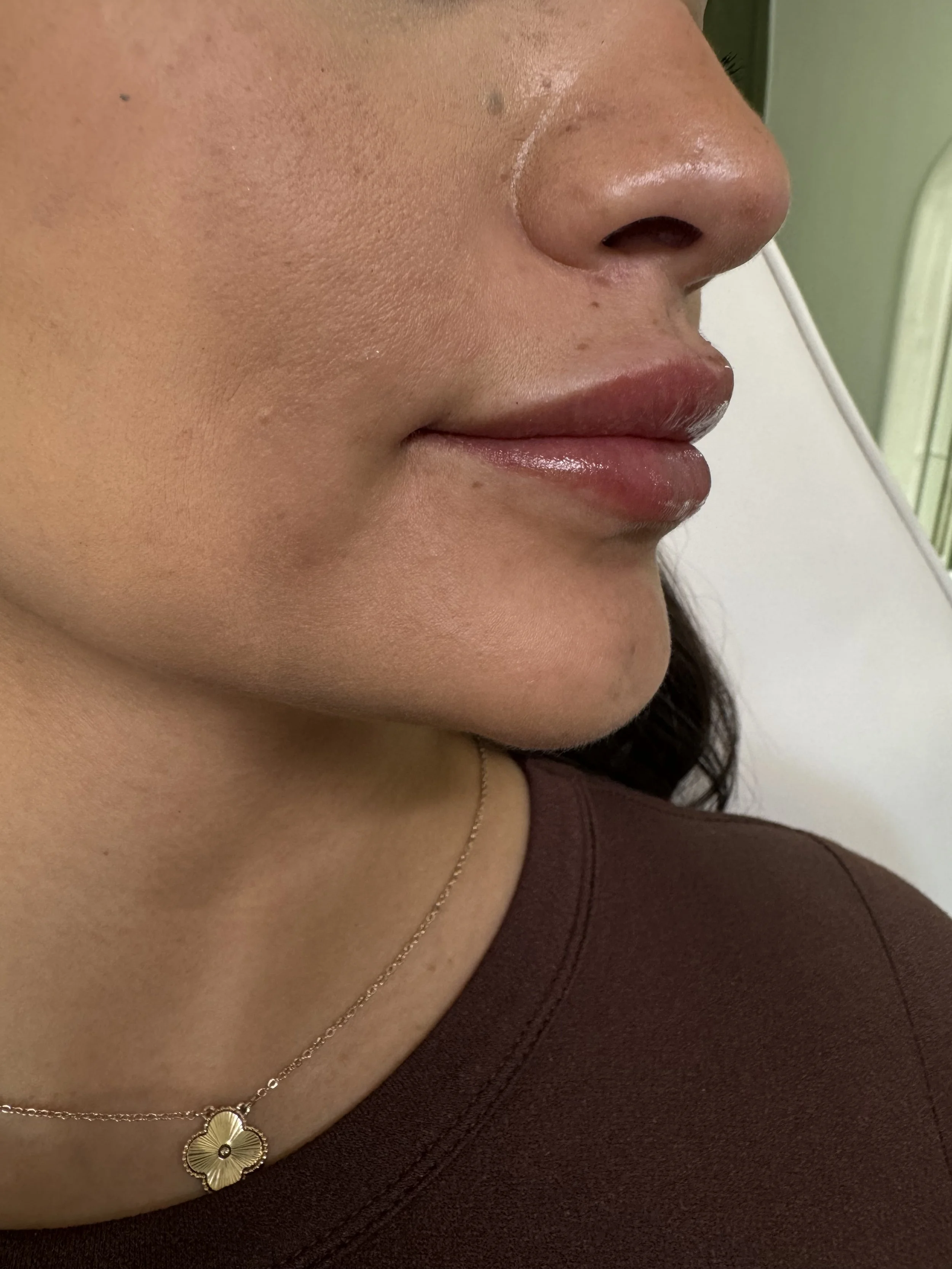 After mini lip enhancement - immediate results