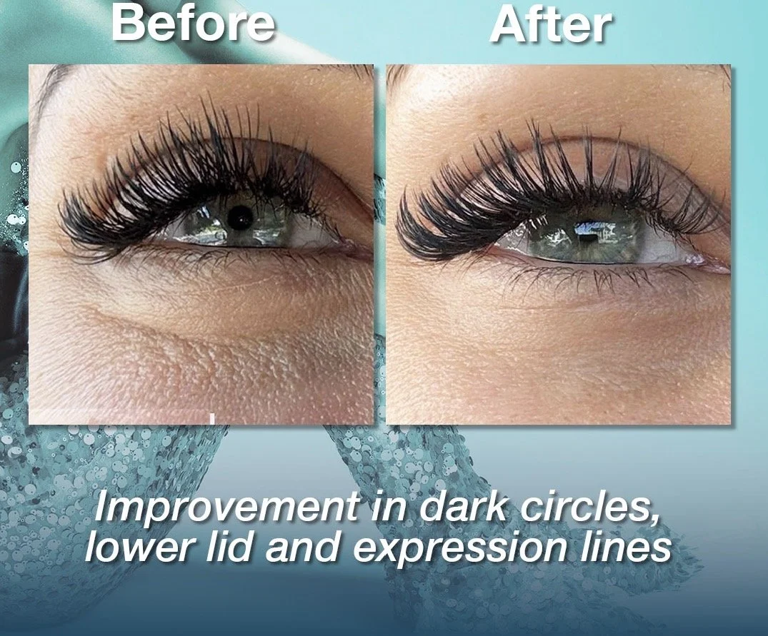 Before and after images of an eye showing improvement in dark circles, lower lid, and expression lines.
