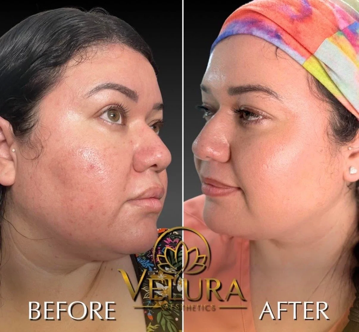 B&A Chemical Peel - 2 weeks results
