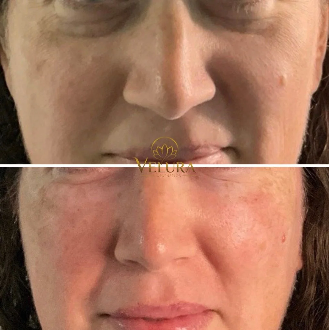 Tear Trough & Under-Eye PRF Session 1 - Immediate sneak peek of long-term results.