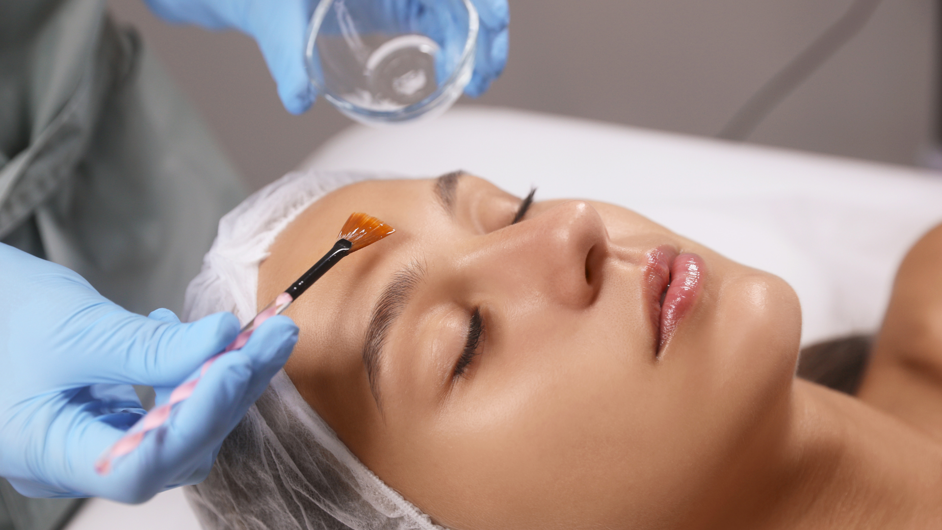 A Beginner’s Guide to Chemical Peels: Reveal Radiant Skin at TDAesthetics MedSpa &amp; Wellness