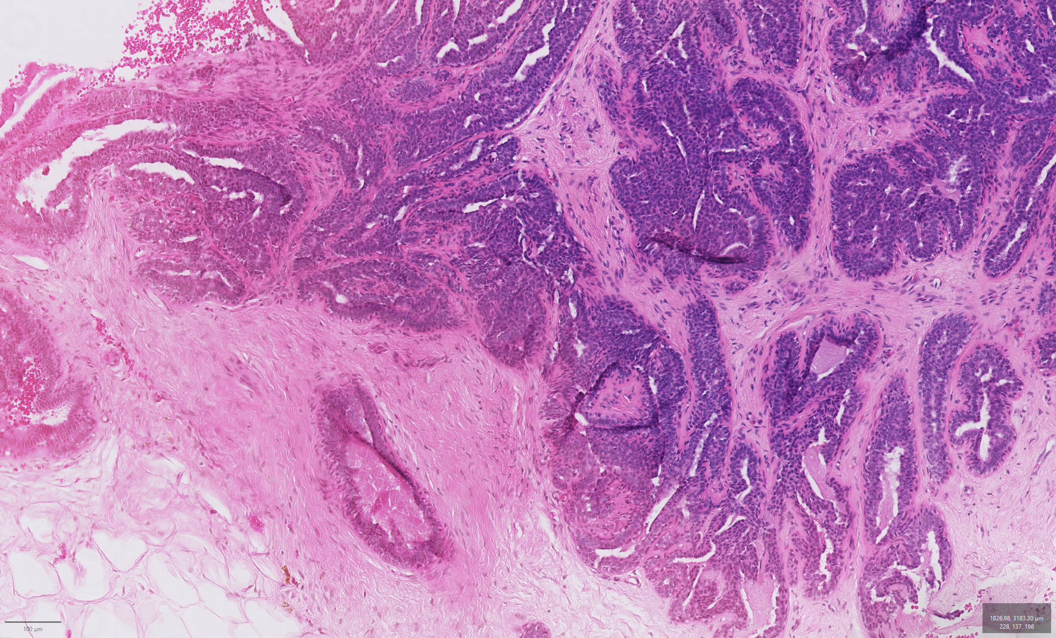 Using Artificial Intelligence (AI) to understand the link between benign breast disease and the risk of developing breast cancer&nbsp;