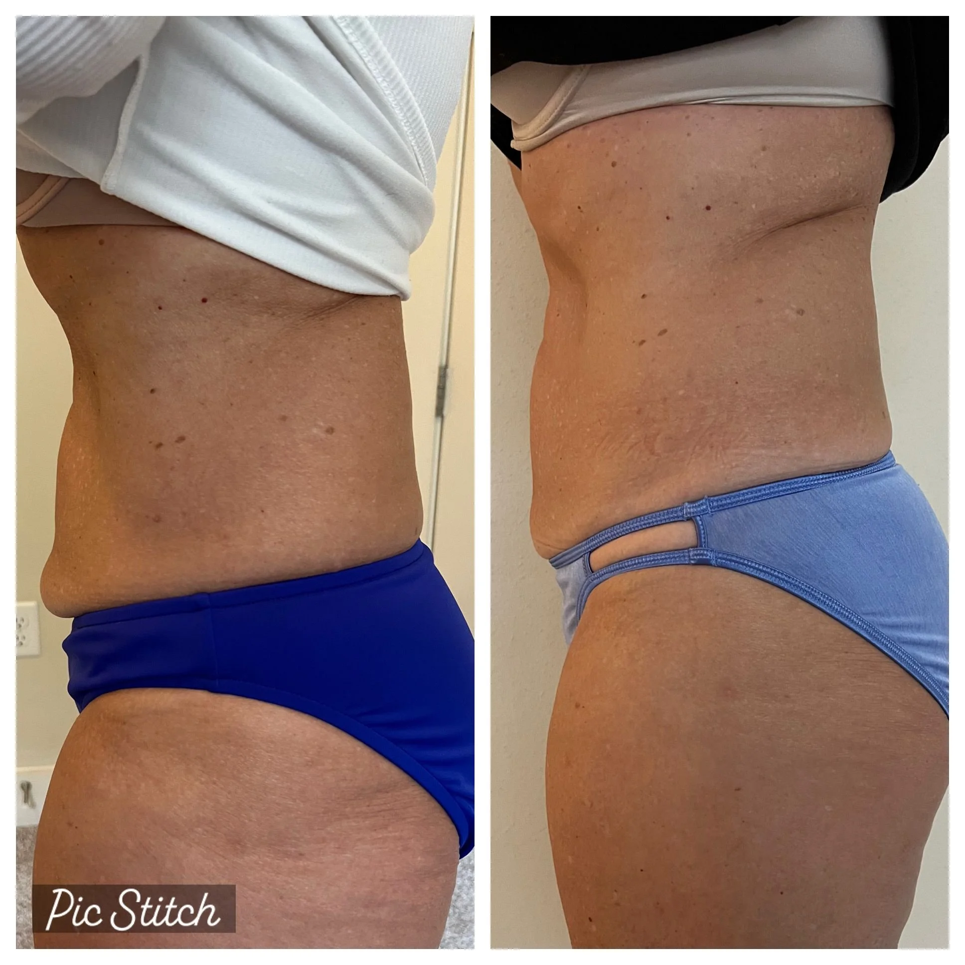 Image 2025-11-25 at 19.50.30_1a95cc46_BEFORE & AFTER THIGH TREATMENT.jpg