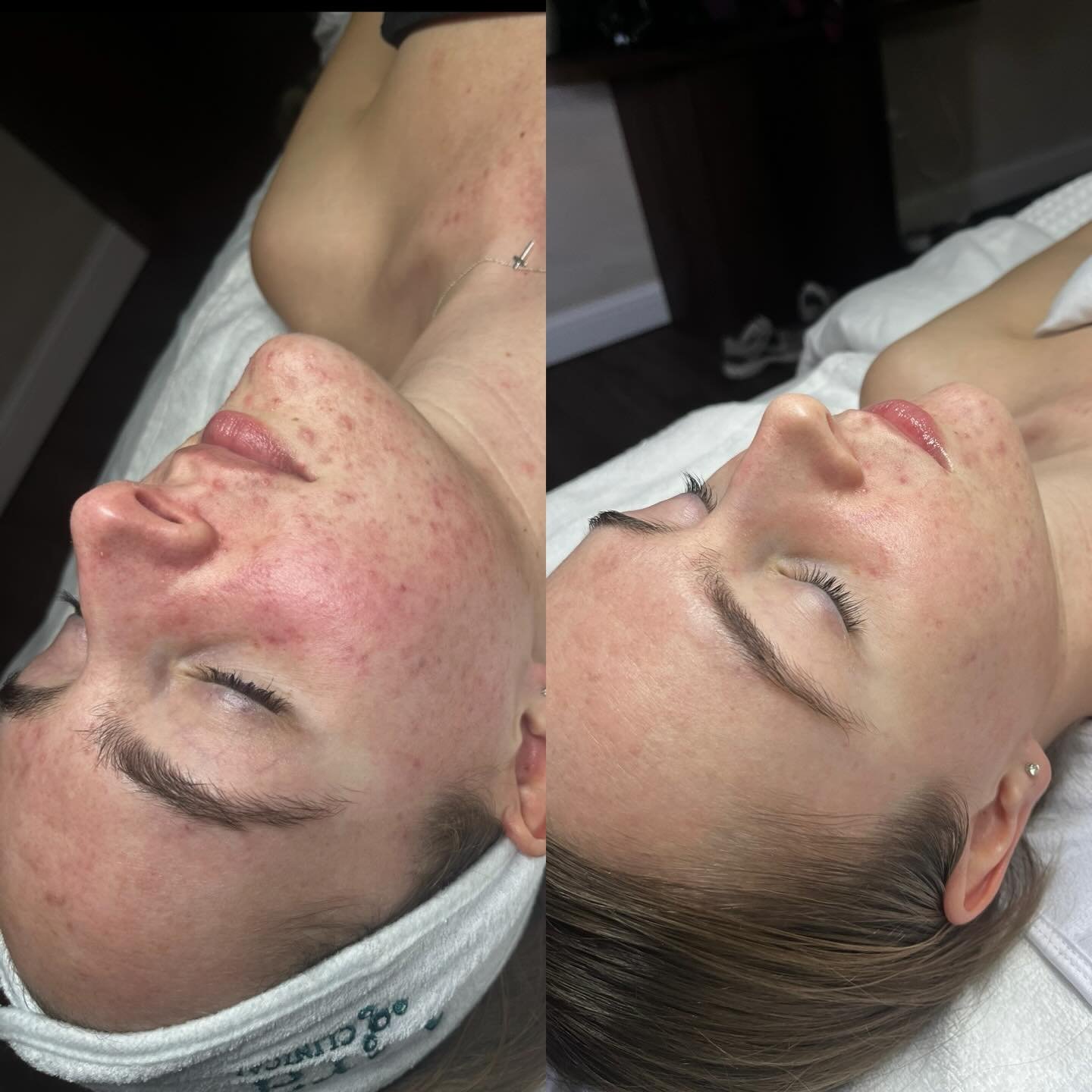 Acne healing begins with barrier integrity 🤎

This seven week transformation has been centered on barrier repair and calming inflammation. Now that the barrier is more supported we have introduced active ingredients to manage breakouts and begin sca