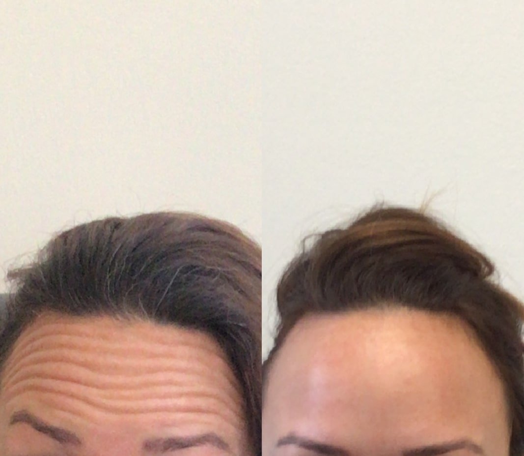 Before and After Forehead Tox