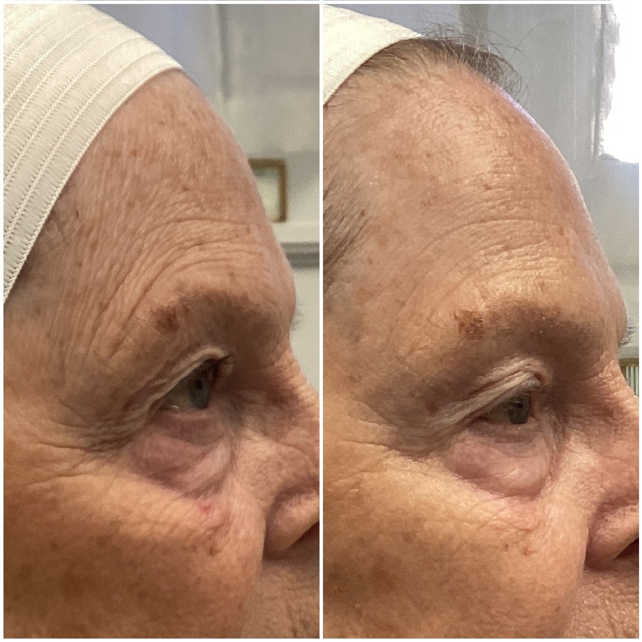Before and After One Session of Microneedling