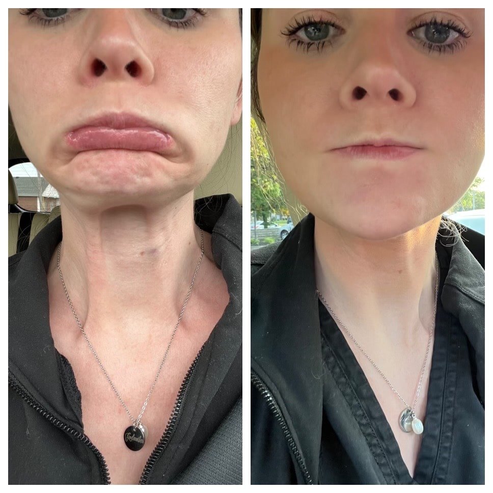 Before and After DAO Treatment