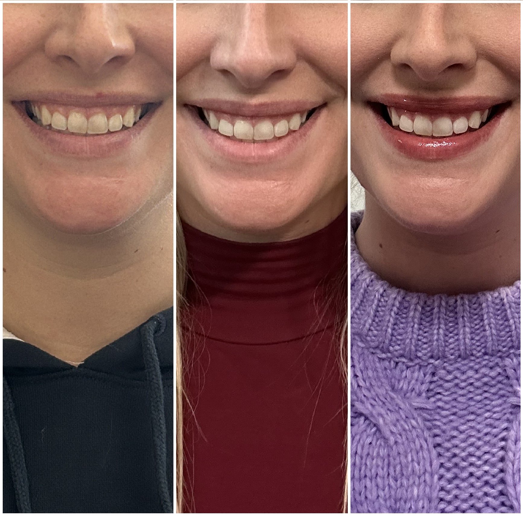 Before and After Treatment for Gummy Smile