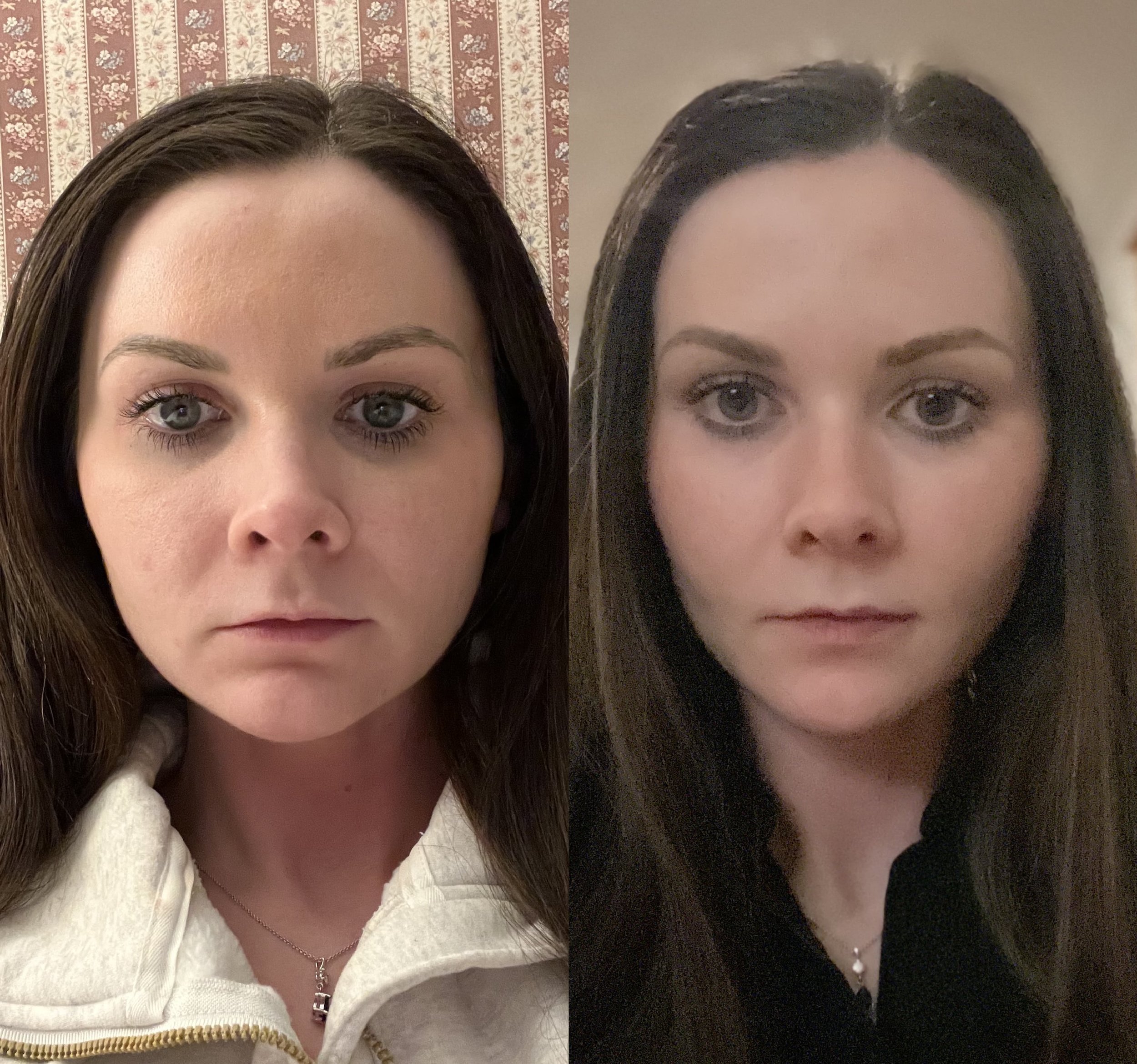 Before and After Masseter
