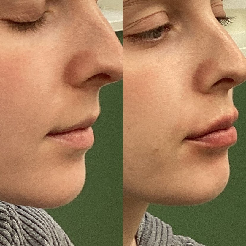 Before and After Lip Filler