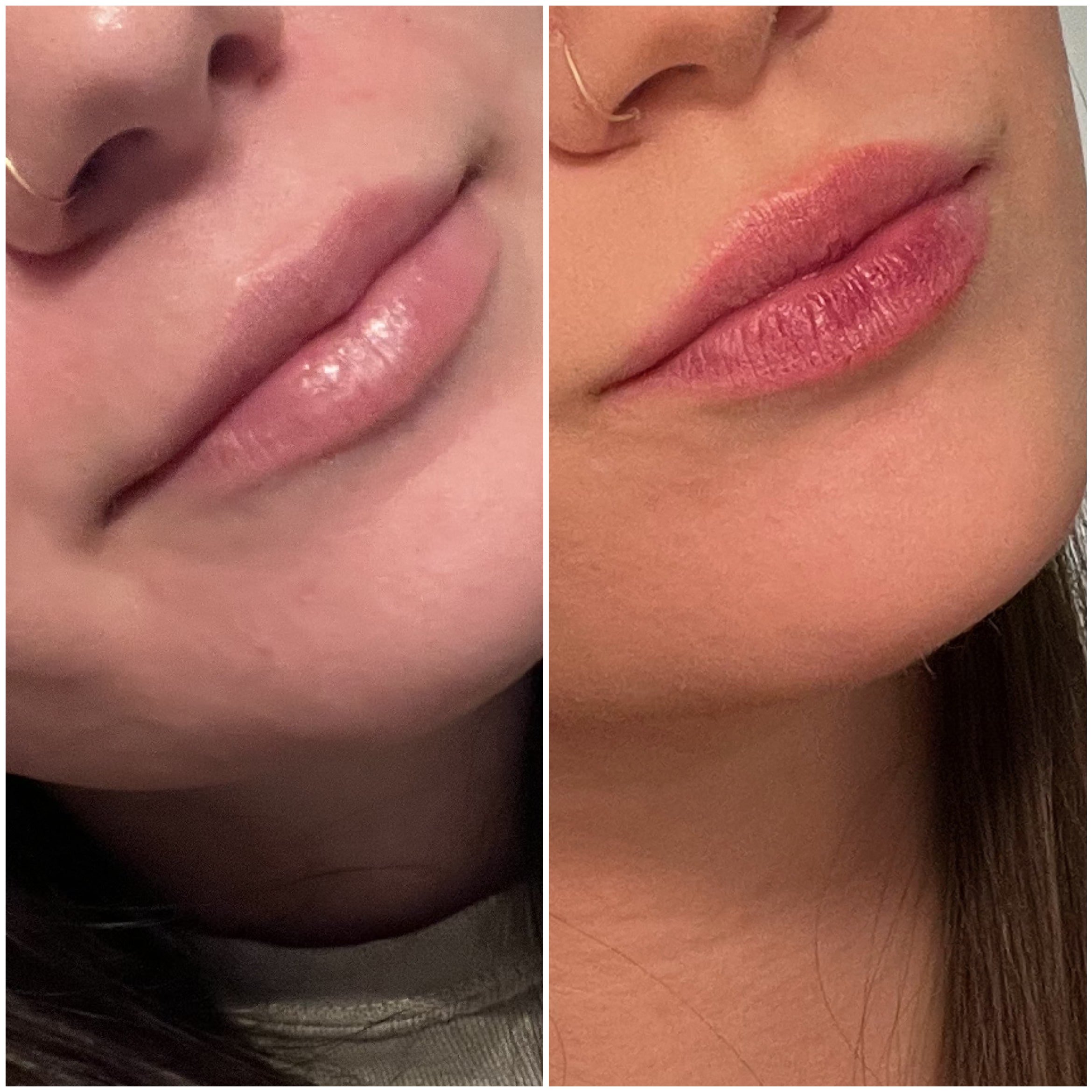 Before and After Lip Flip
