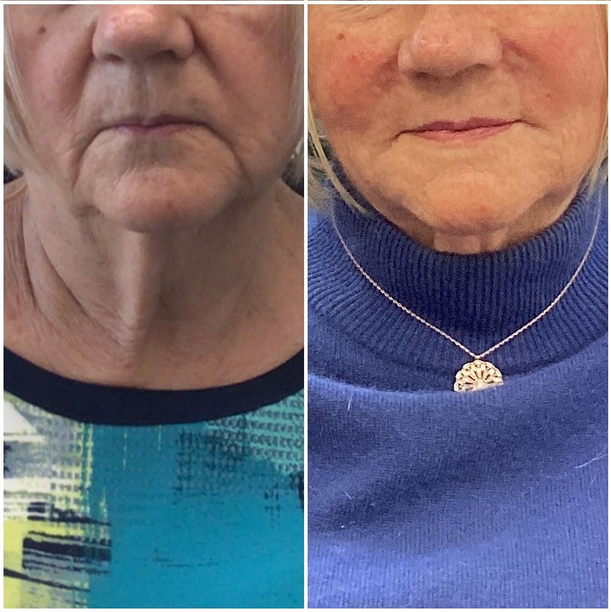 Before and After Lower Face Filler
