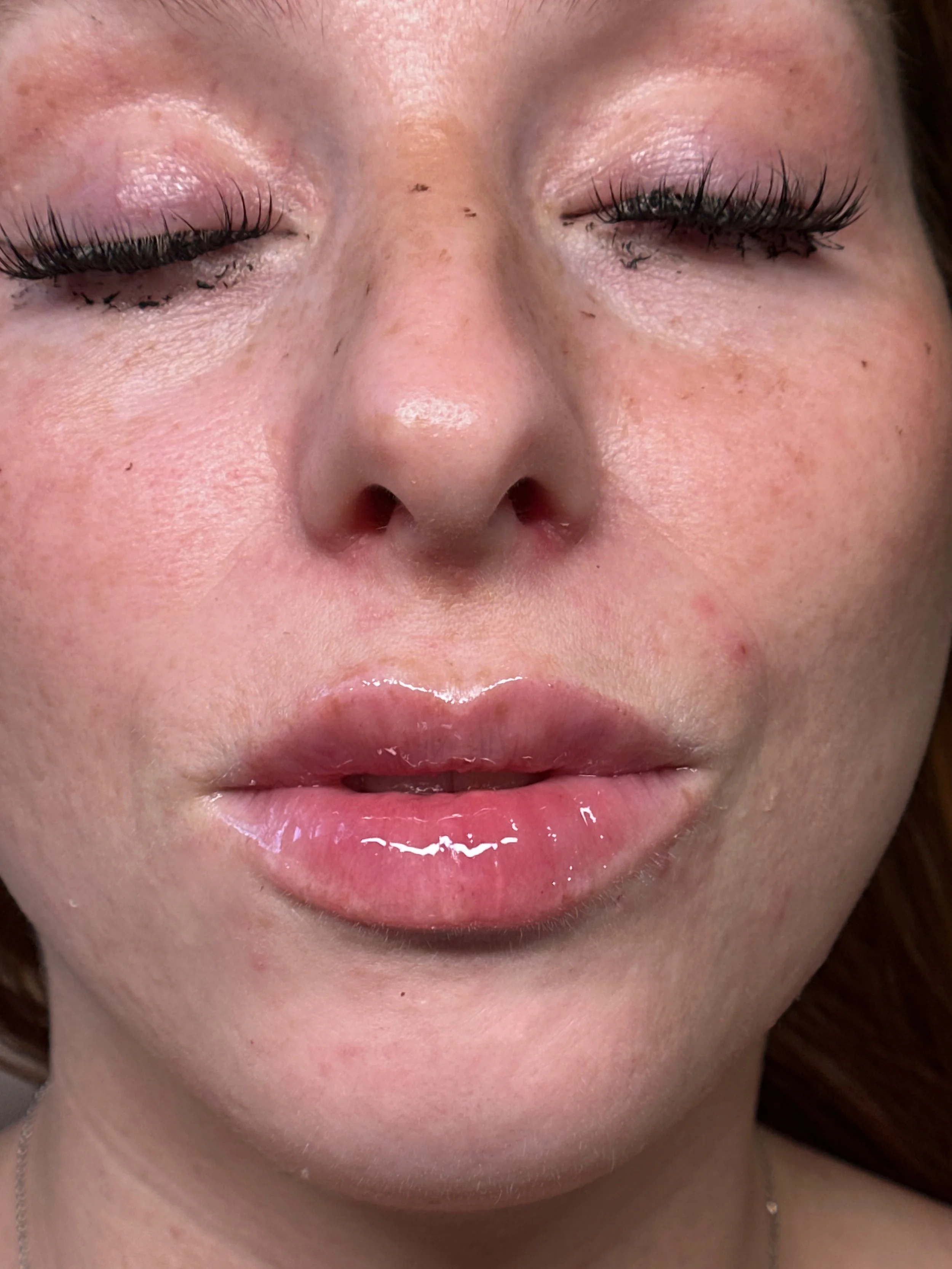 hyaluron pen lip filler. near me