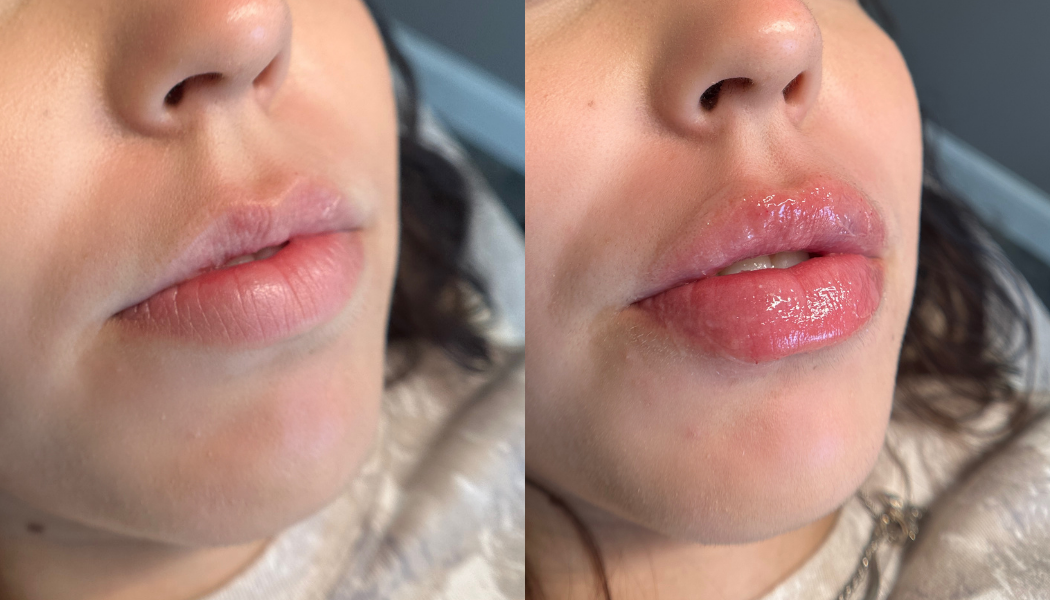 hyaluron pen sacramento california