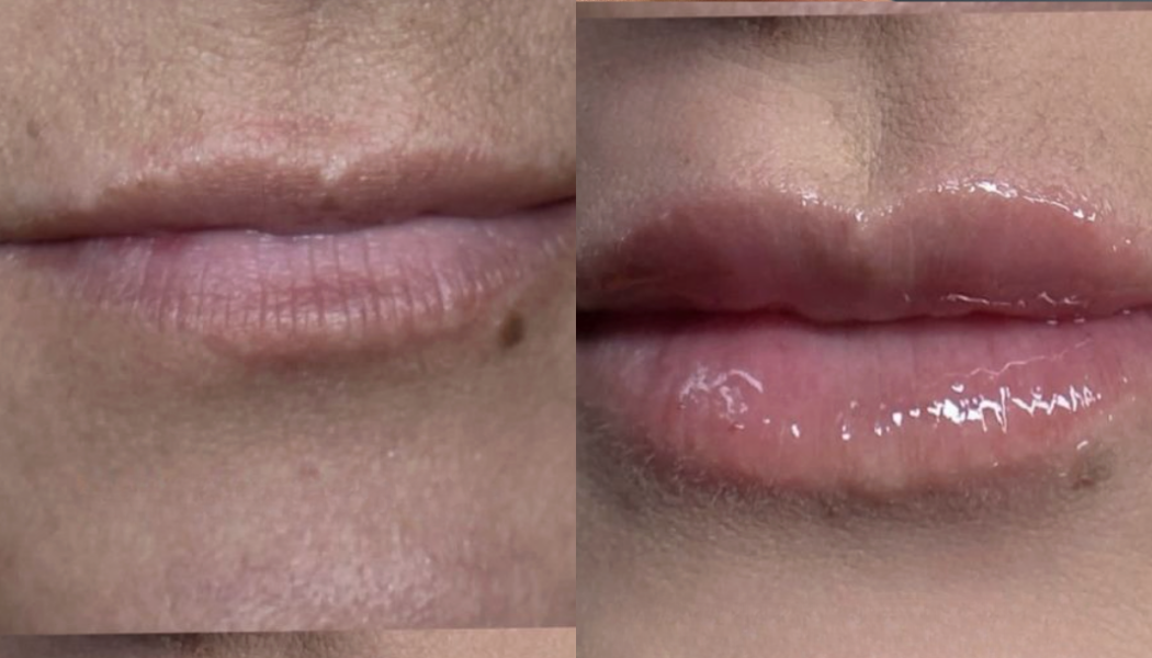 hyaluron pen near me