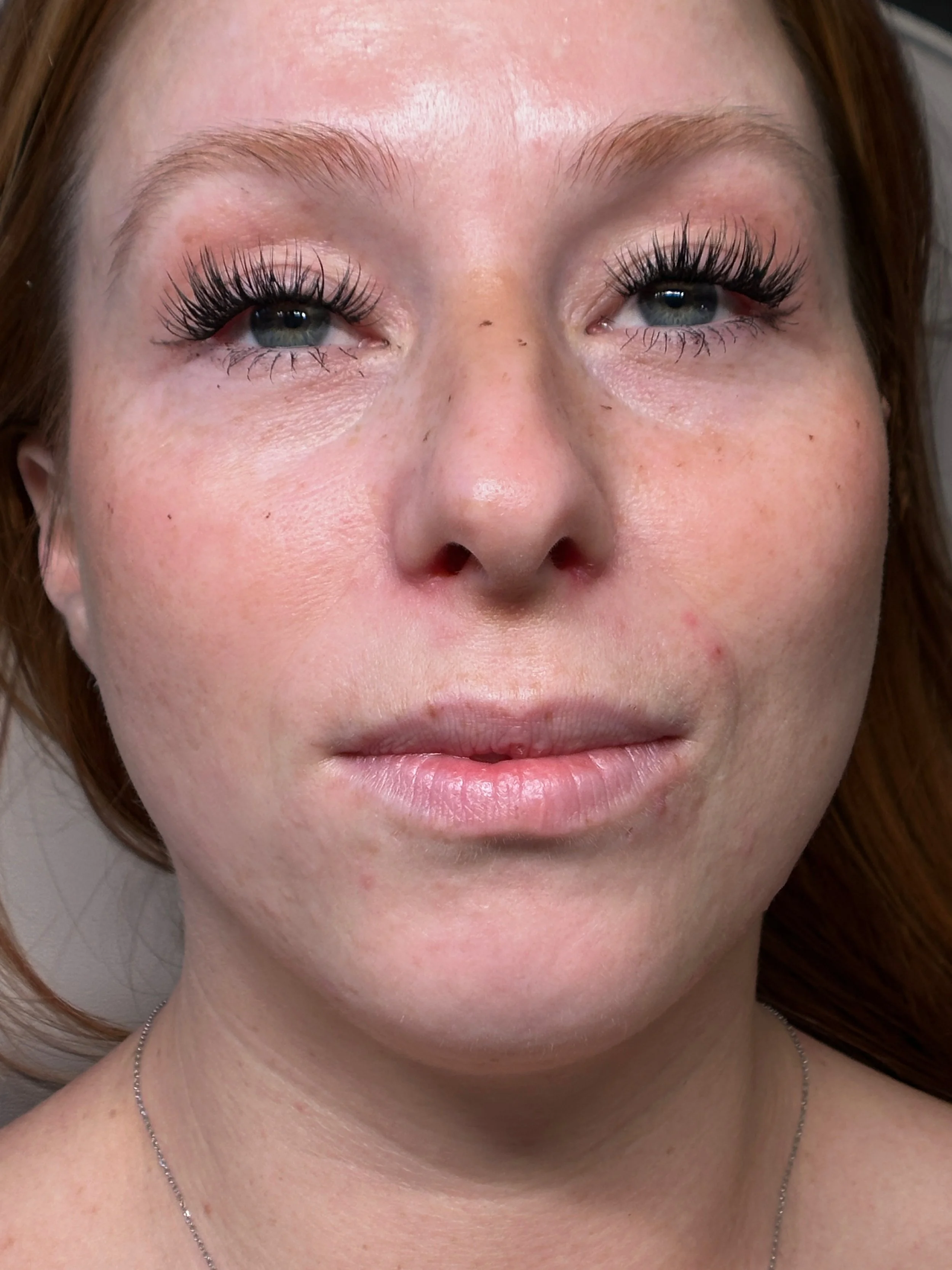 needle-free lip filler near me