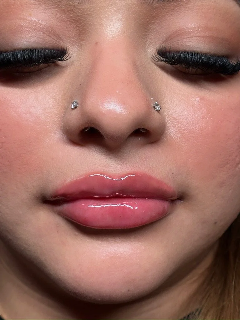 needleless lip filler