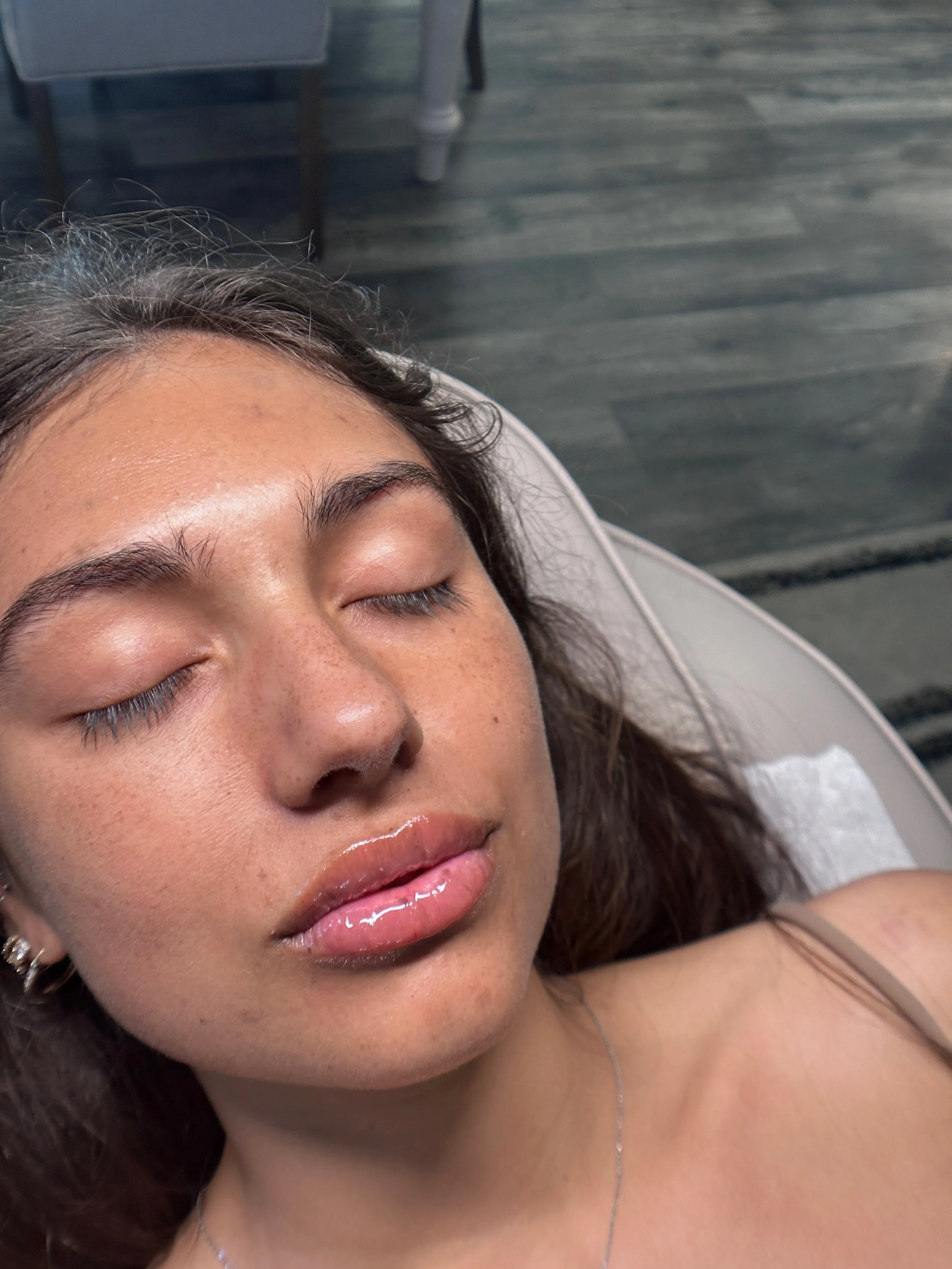 hyaluron pen lip filler sacramento