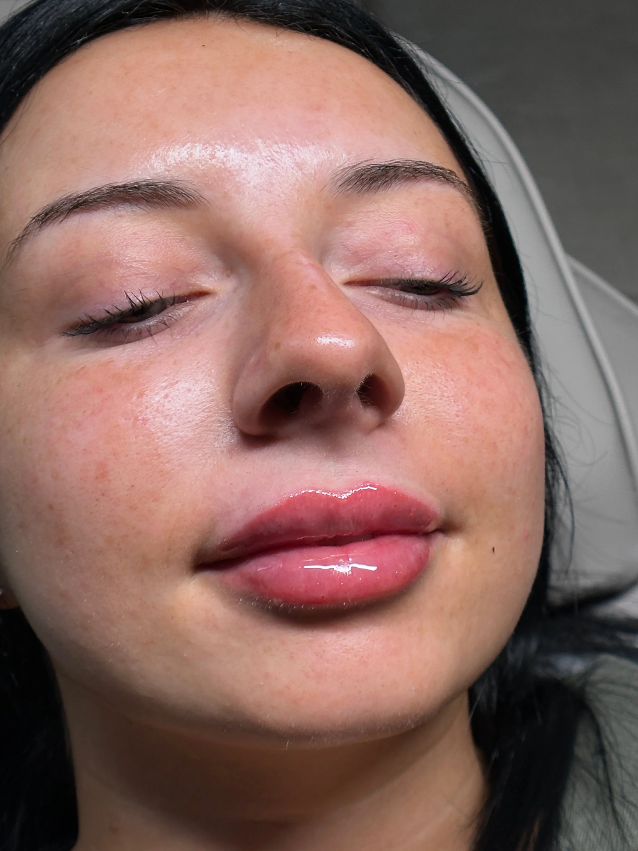 sacramento lip filler