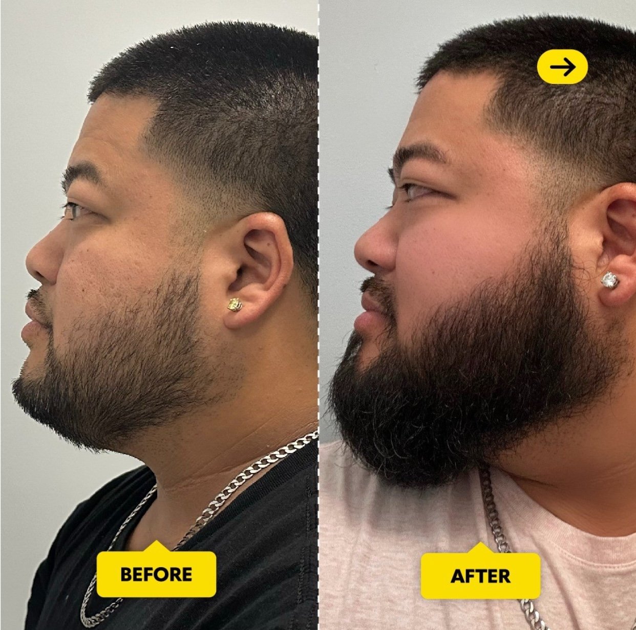 Chrome Hair Growth Serum – Natural Hair & Beard Growth Treatment | Fills Patches & Promotes Thicker Hair | 1-Month, 3-Month & 6-Month Bottles