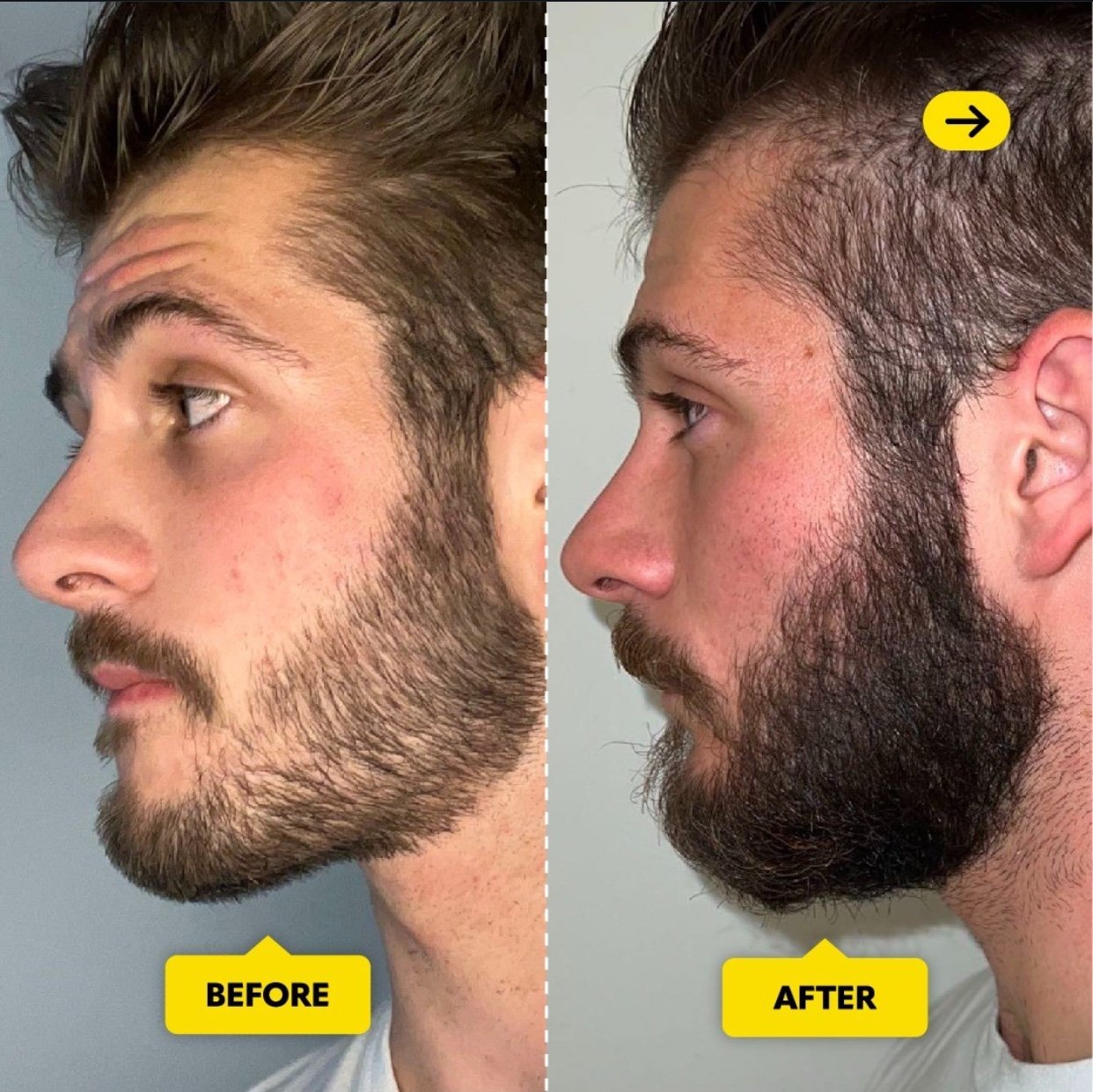 Chrome Hair Growth Serum – Natural Hair & Beard Growth Treatment | Fills Patches & Promotes Thicker Hair | 1-Month, 3-Month & 6-Month Bottles